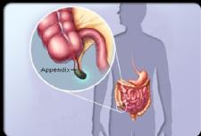 Appendicitis Can Often Be Treated With Antibiotics