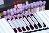 Blood Test Might Spot Pancreatic Cancer Early, Study Finds