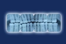 Dental X-Rays May Be Linked with Brain Tumors