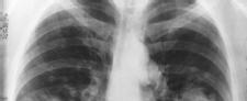 Medicare Plans to Pay for Lung Cancer Screening