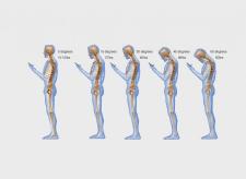 'Text neck' is becoming an 'epidemic' and could wreck your spine